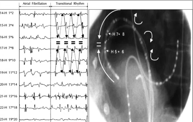 Fig. 6. Hypothetical mechanism of activation sequence in transitional rhythm. Sudden change in the activation sequence resulted from block of conduction along the right atrial free wall, led to the development of  tran-sitional rhythm