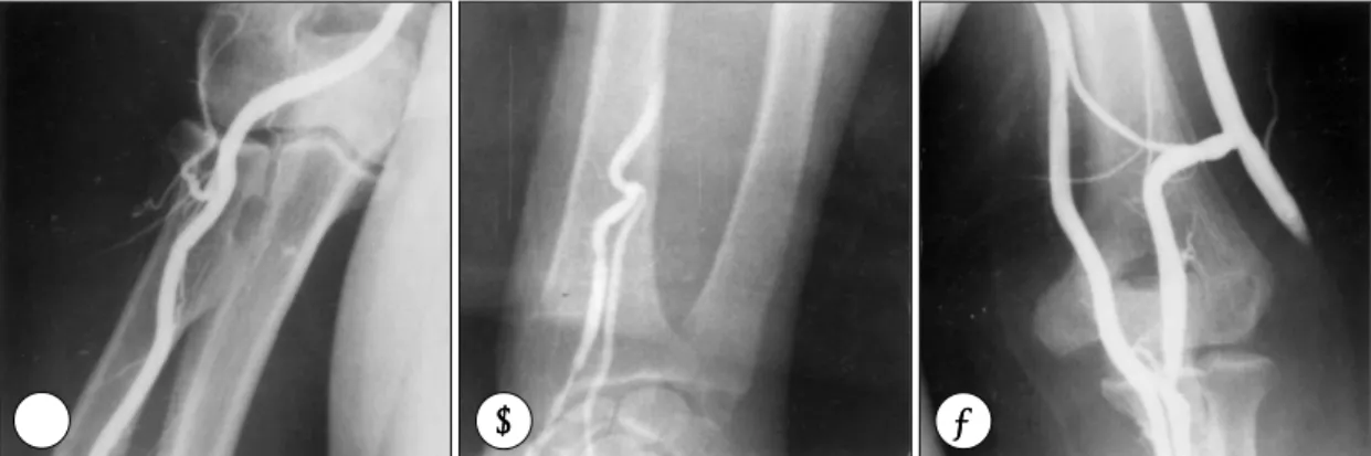 Fig. 1. The anomalous branching patterns of upper extremity artery. Retrograde angiogram showed high origin of radial artery (A), double radial artery (B) and double brachial artery (C)