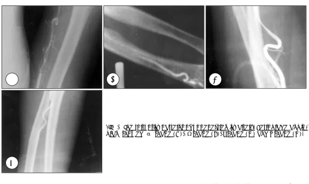Fig. 2. The tortuosity patterns of upper extremity artery. Retrograde angio- angio-gram showed  α shape (A),  Ωshape (B), Z shape (C) and S shape (D)