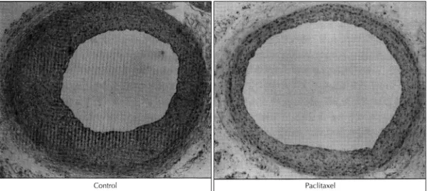 Fig. 3. Cross sections (100X) of the rat carotid artery taken 14 days after balloon injury demonstrate significant inhibition of neointimal formation and subsequent reduction of luminal narrowing in paclitaxel-treated group
