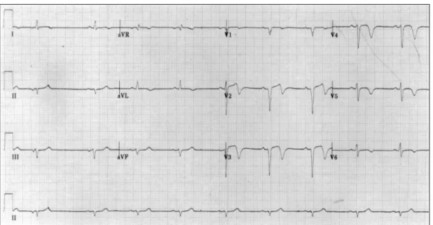 Fig. 2. Electrocardiogram shows the old anterior myocardial infarction seven months after acute myocardial in-