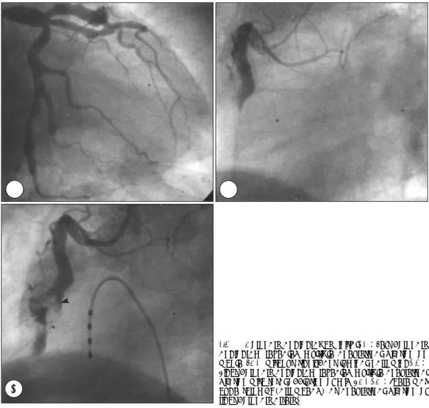 Fig. 1. Coronary angiography, initial. A：Left coronary angiogram revealed multiple aneurysmal dilation on whole LCA without significant luminal narrowing