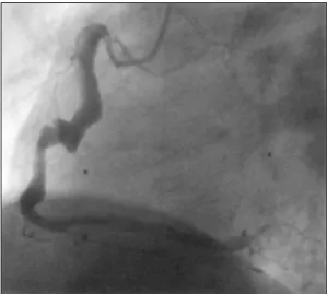 Fig. 3. Abdominal aortogram along with renal, mesenteric and splanchnic angiogram revealed multiple aneu- aneu-rysms (arrow-head) in the right renal (A) and superior mesenteric arteries (B)