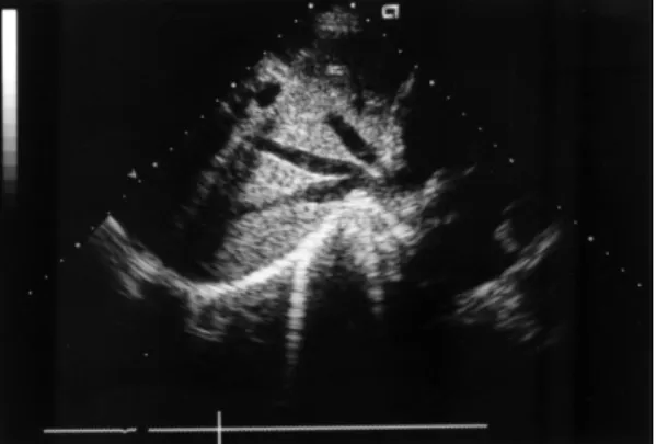Fig. 5. Dilated azygous vein connected by suprior vena cava (A, B, C) and the congenital absence of inferior vena cava (D) were visualized by Chest CT scan