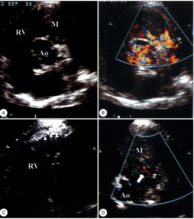 Fig. 2. A：Parasternal short axis view obtained by two-dimensional echocardiography. The echocardiogram shows a large mass (M) in the right ventricular outflow tract