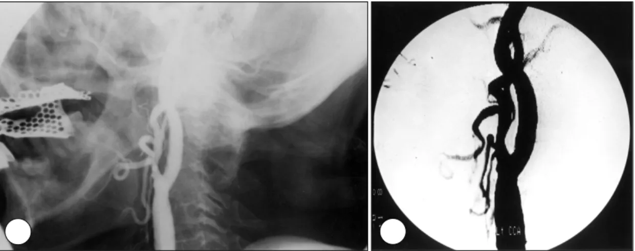 Fig. 6. After carotid artery stenting, left anterior oblique angiogram (A) and digital subtraction angiogram (B) showed complete coverage of stenotic lesion
