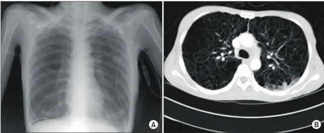 Fig. 2. Chest PA at the time of discharge after right single lung transplantation.