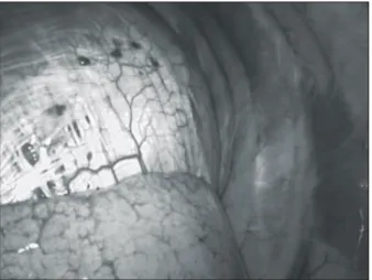 Fig. 2. Diaphragm lesions were resected with endoscopic stapl- stapl-ing devices.