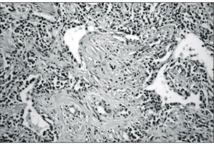 Fig. 3. The tumor contains a mixture of spindle cells showing  fibroblastic and myofibroblastic differentiation arrayed in  fas-cicles, or storiform architecture