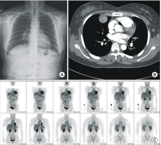 Fig. 1. Chest PA (A) and chest  CT (B) shows multiple nodules on right lung field PET (C) shows no hypermetabolism.
