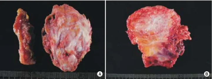Fig. 1. The cut surface of the masses are variegated in appearance with mixture of gray-white fibrotic areas and yellow fatty areas (A: Left B: Right).