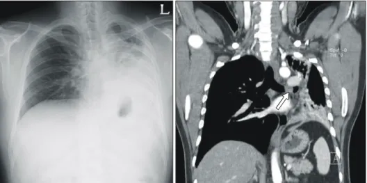 Fig. 2. Pre-operative bronchoscopy: The bronchoscopy shows  total obstruction of left main bronchus by hypervascular  endo-bronchial mass.