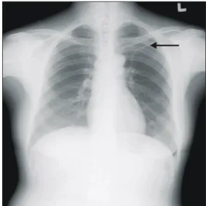 Fig. 1. Chest x-ray shows a needle-like metallic foreign body in left upper lobe (arrow)