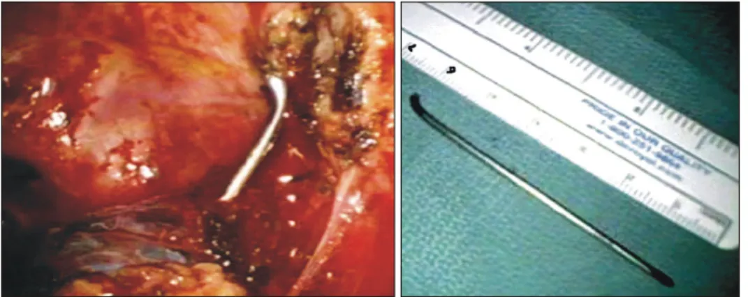 Fig. 3. Thoracoscopic finding of mi- mi-grated Kirschner wire and removed  Kirschner wire.