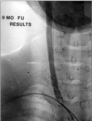 Fig. 3. Angiographic findings of left internal carotid artery. A：Pre-stenting, B：Immediate post-stenting, C：Re- C：Re-stenosis after 21 months, D, E：Stenting in reC：Re-stenosis lesion, F：Patent left internal carotid artery after 5 months