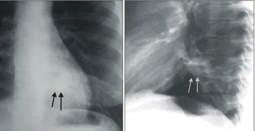 Fig. 2. Well-enhancing nodular lesion at left lower medial lung zone (A), increased vascularity of left lower lobe (B), and normal  pulmonary  parenchyma and bronchial structure are noted (C, D) in chest CT with enhancement.