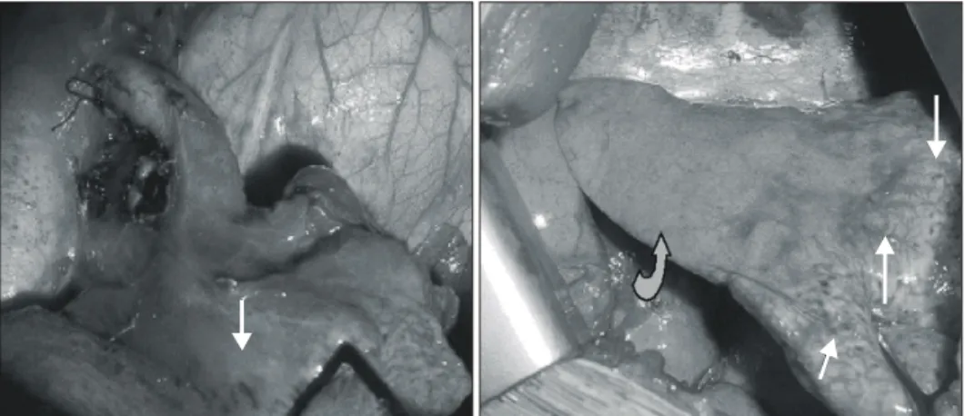 Fig. 5. Anormalous artery is noted at  left lower medial lung zone on  en-hanced CT (A)