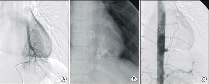 Fig. 6. Venous phase of selective arteriography shows draining vein to normal left inferior pulmonary vein (A)