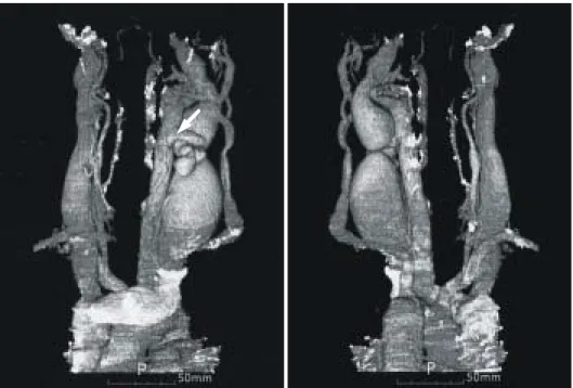 Fig. 2.  Neck  MDCT  with  3D  re- re-consturction shows markedly  dila-tated LCCA and severely stenotic  LIJV