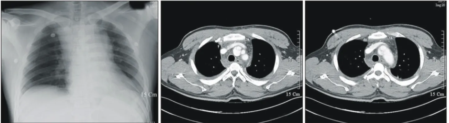 Fig. 2. 3D reconstruction of preoperative CT scan showing pseudo- pseudo-aneurysm of innominate artery.