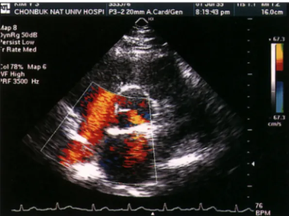 Fig. 3. Initial Doppler transthoracic echocardiogram  revealed shunt flow from left atrium to right atrium