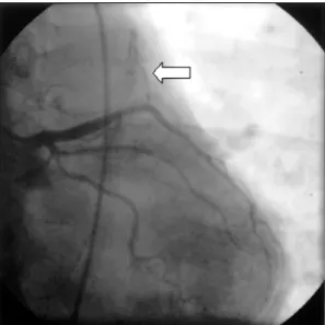 Fig. 5C. LAO 49° Cranial 35° projection of left coro- coro-nary artery. 