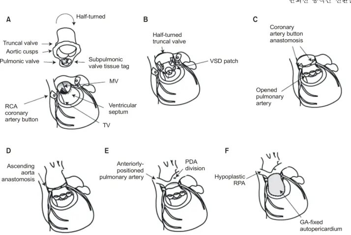 Fig. 2. Operative scheme. (A) The truncal block involving both semilunar valves was separated from the ventricular outflow tract