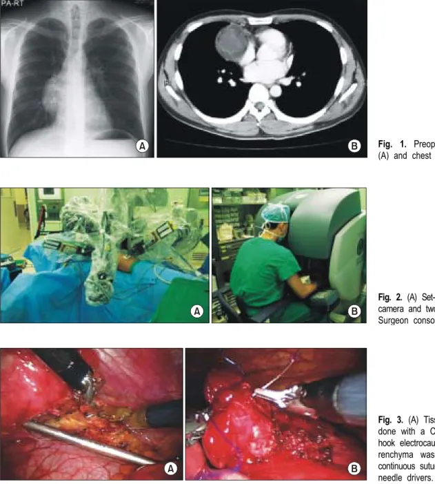 Fig. 1. Preoperative chest PA  (A) and chest CT scan (B).