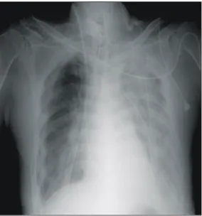 Fig. 3. Chest PA taken 1 day after the left lower lobe lobec- lobec-tomy of transplanted lung.