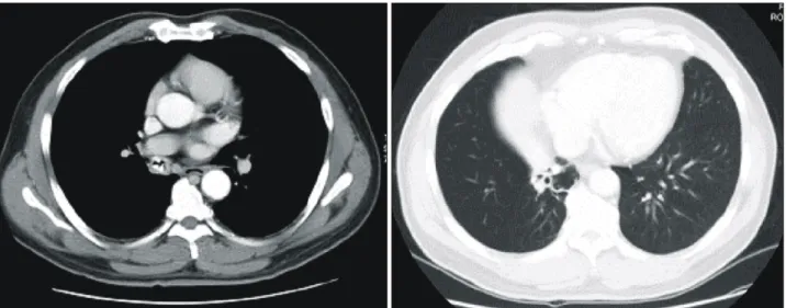 Fig. 2. Chest CT showing calcified material in bronchus intermedius and atelectasis of right middle lobe.