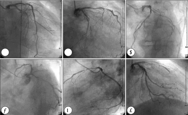 Fig. 1. Serial changes of left coronary artery during diagnostic coronary angiogram (CAG)