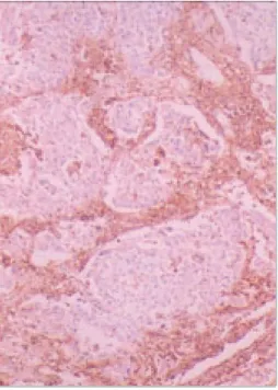 Fig. 3. The tumor cells in an undifferentiated large cell car- car-cinoma are non-reactive for CD44s, whereas many lymphoid  cells in the stroma show strong immunoreactivity  (×200).