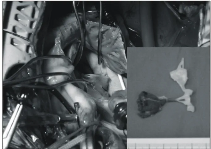 Fig. 2. The anterolateral papillary muscle was completely rup- rup-tured.