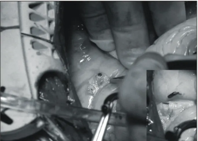 Fig. 3.  A fresh thrombus was found at the proximal site of the first diagonal branch and removed easily with forceps.