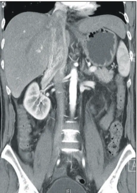 Fig. 3. Pump driven veno-venous bypass technique. Cannulation at distal IVC and RA appendage is enough to maintain  hemo-dynamic stability and prevent from thromboembolism