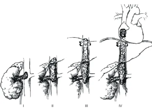 Fig. 4. Classification of IVC ob- ob-struction due to renal cell  carcino-ma. IVC=Inferior vena cava.