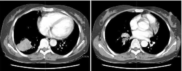 Fig. 1. Chest CT shows 4×5 cm sized mass and enlarged  peribronchial lymph node.