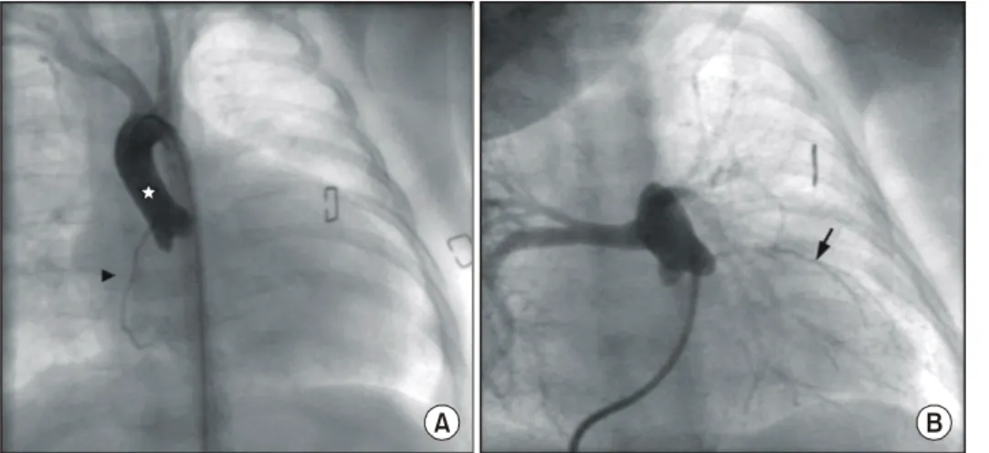 Fig. 4. The angiogram of case 6.