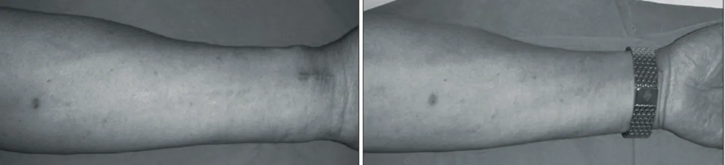 Fig. 5. Post-operative wound is so minimal. The distal scar can be invisible on wearing a watch