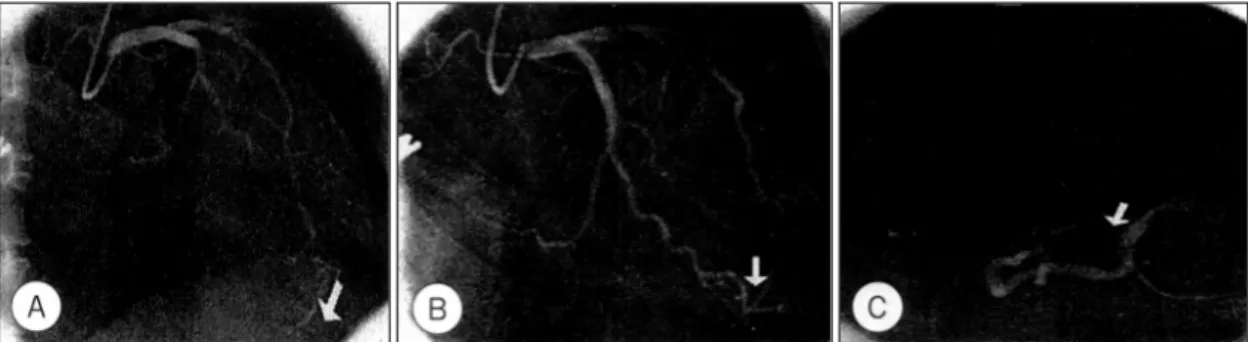 Fig. 1. Examples of landmark branch in coronary arteries. A：Landmark branch of left anterior descending artery；“wh- artery；“wh-ale’s tail”appearance