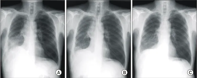 Fig. 2.  (A) Chest radiograph at the 16th postoperative day showing pleural effusion and passive atelectasis on the right lower lung field