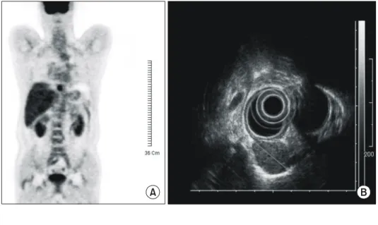 Fig. 2. On section, it is circumscribed, lack of a true capsule, and reveals a gray-white cut surface with rubbery consistency.