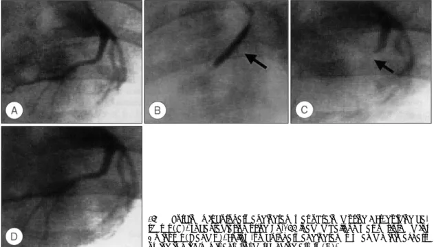 Fig. 1. Porcine left coronary angiogram was obtained using 8 Fr. guiding ca- ca-theter (A)
