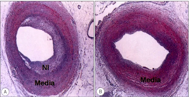 Fig. 3. Neointimal area and histopathologic area stenosis were higher in control artery (A) than in locally radiated artery using Ho-166 balloon (B)