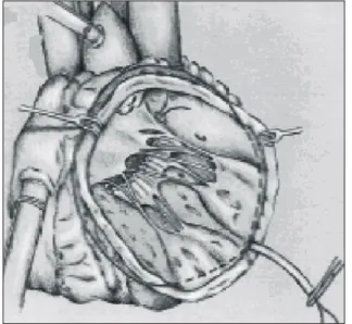 Fig. 4. Two arms of stitch with running suture that completely  bounds the posterior annulus are seen