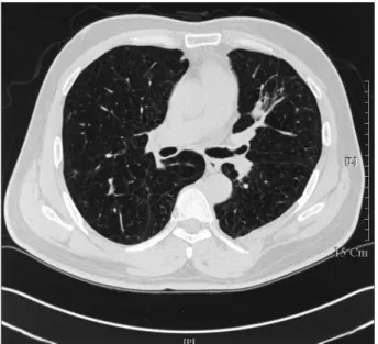Fig. 2. HRCT shows irregular shaped multiple thin-walled cystic cavities and nodules diffusely distributed throughout.
