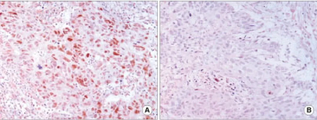 Fig. 4. Immunohistochemical stating of Ki67. Ki67 nuclear antigen was stained reddish brown, the index of Ki67 is high  (A) and low (B).