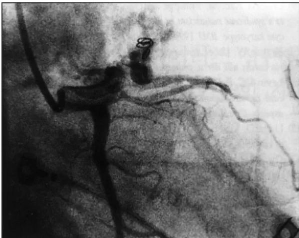 Fig. 2. Repeat angiography after coil embolization sh- sh-ows complete closure of the main fistula with faint  re-sidual flow through another small fistula