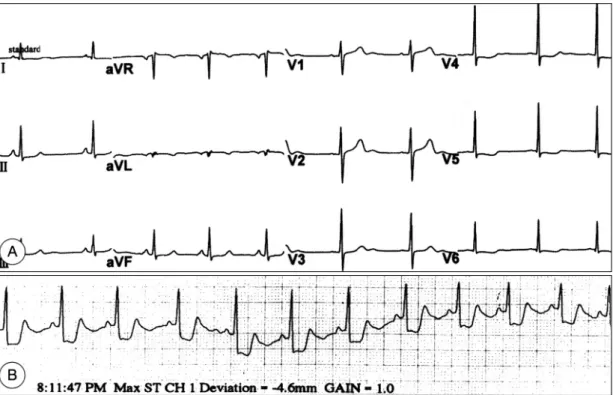 Fig. 1. A：Resting ECG on admission showed depressed ST segment in lead I, aVL, and V 4-6 