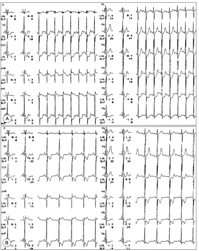 Fig. 2. Treadmill exercise stress test using Bruce protocol revealed significant ST segment depression in lead  Ⅱ,  Ⅲ, aVF, and V 4-6  with chest pain